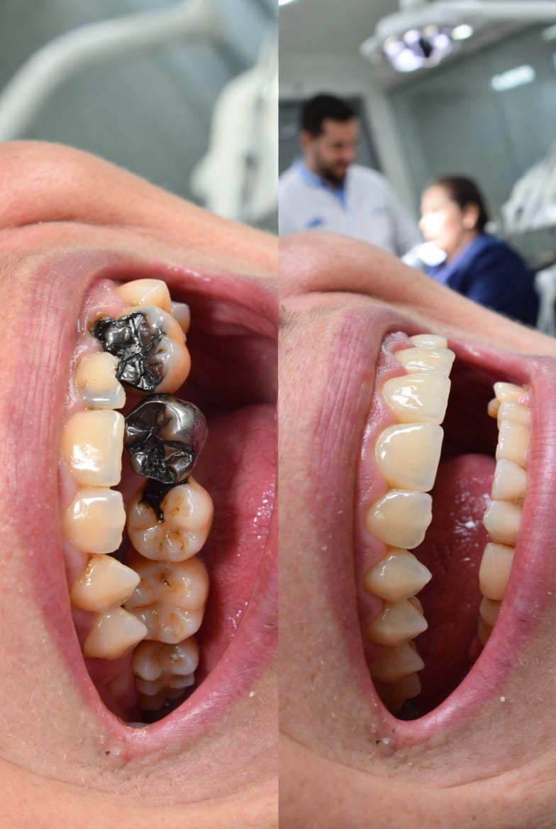 The Invisible Repair: How Modern Tooth-Colored Fillings and CEREC Restorations Preserve Your Smile