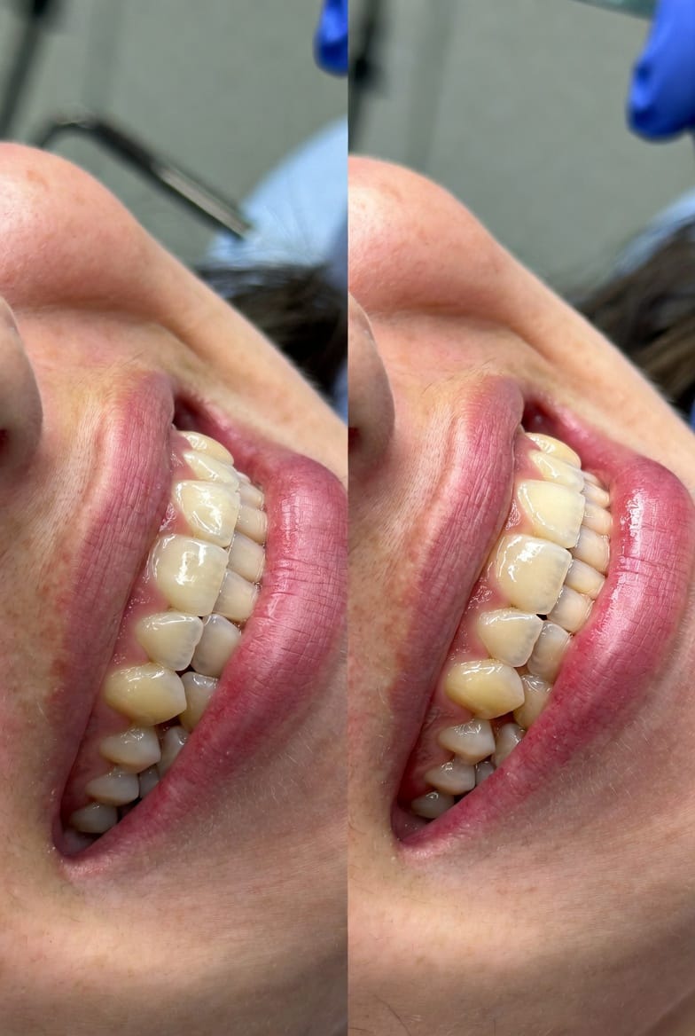 The Crown Lengthening: Reshaping Gum Tissue for Better Dental Health and Aesthetics
