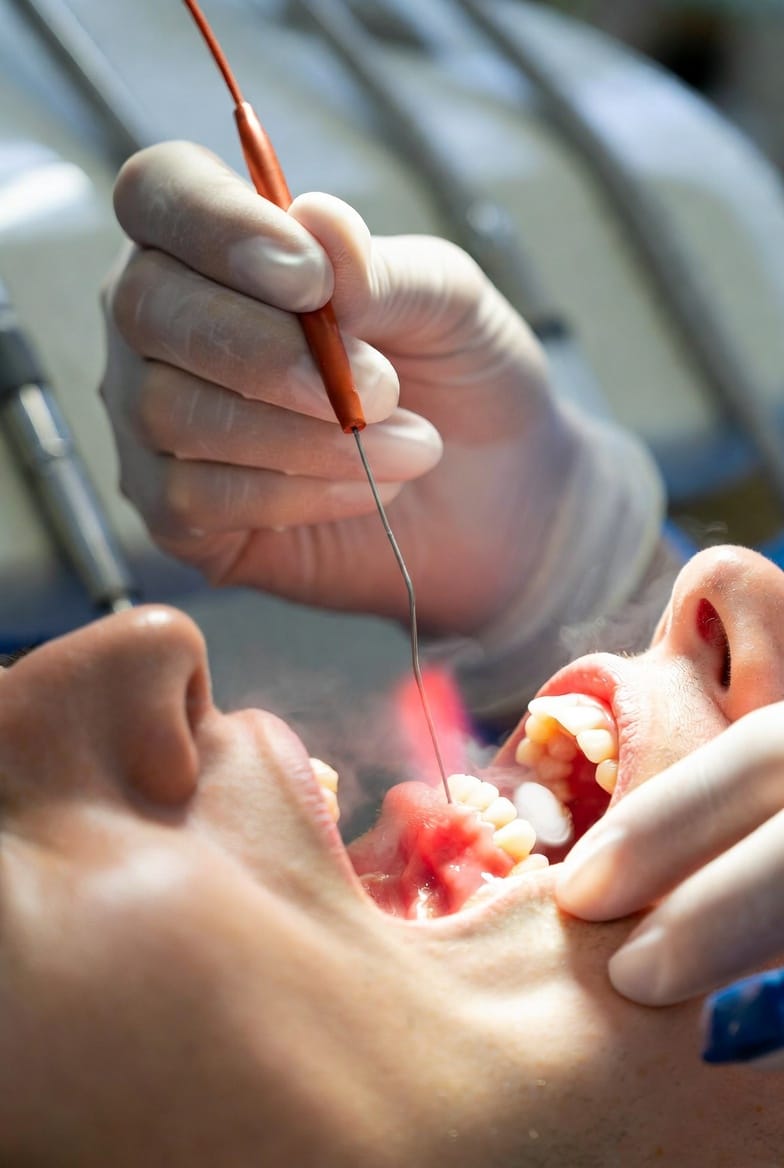The Dental Laser for Gum Disease: LANAP Protocol Explained